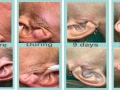 Fibroblast before afters Linda Fibroblast before afters Linda
